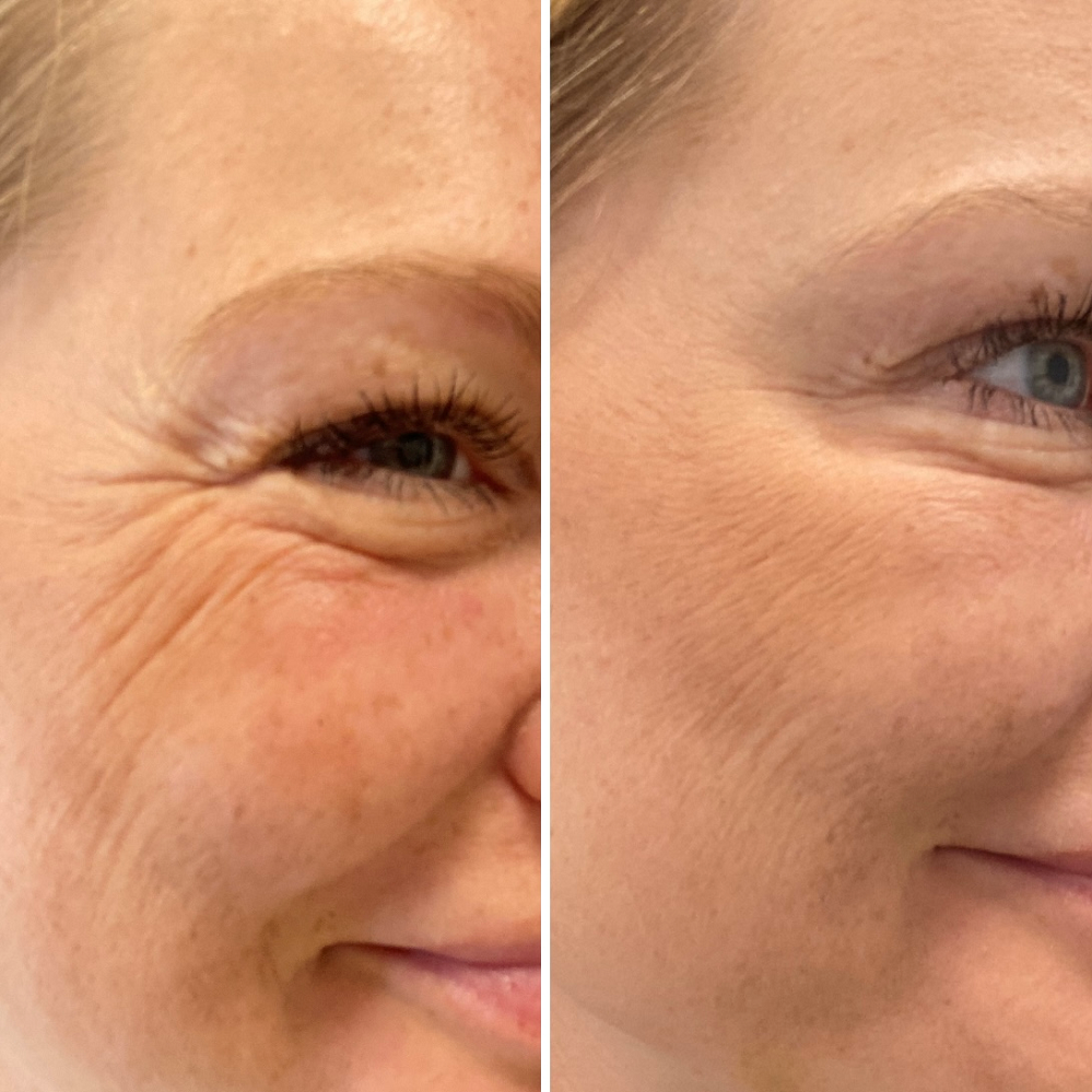 Botox omkring øjne - FØR OG EFTER