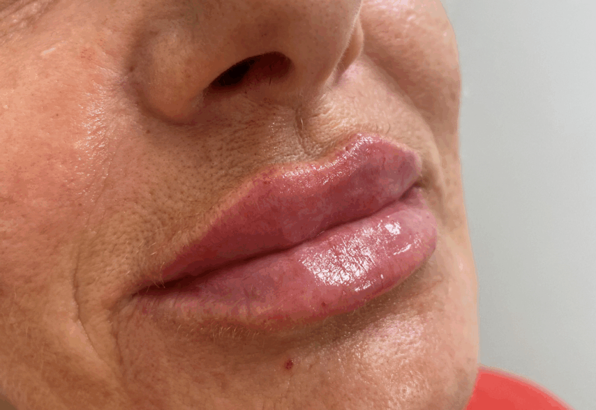 Læber behandlet med 1ml filler